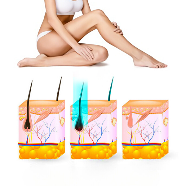 Yui IPLV15 Pro Vücut Yüz Bikini Başlıklı Ağrısız Otomatik ve Manuel Atım Buz Lazer Epilasyon Cihazı - Siyah